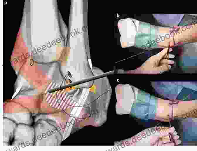 Anterolateral Ankle Exposure (Brostrom Gould Approach) Master Techniques In Orthopaedic Surgery: Relevant Surgical Exposures