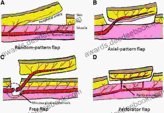 Blood Supply Of The Duke Flap The Workhorse Flaps Latissimus Dorsi: Duke Flap Course Dissection Guide (Duke Flap Course The Workhorse Flaps 1)