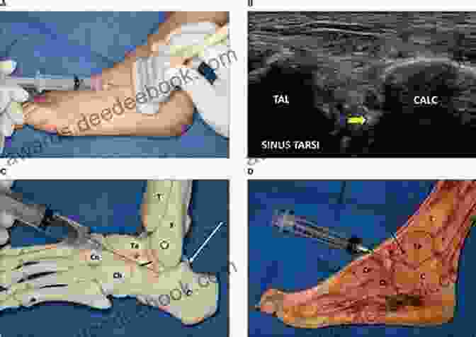 Subtalar Joint Exposure (Evans Approach) Master Techniques In Orthopaedic Surgery: Relevant Surgical Exposures