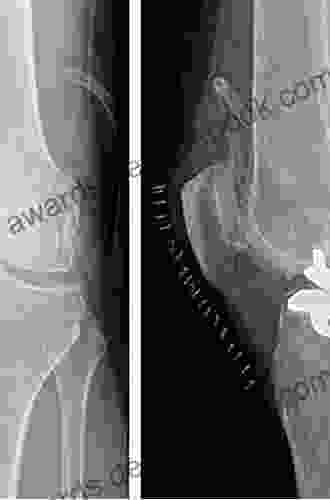 Unicompartmental Knee Arthroplasty E Iman Elwan